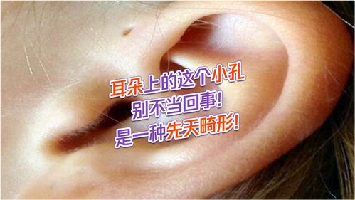 耳朵两边有小孔运势(耳朵旁边两个小孔)